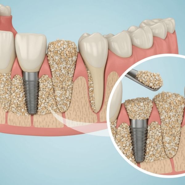 Bone grafting procedure for dental implants