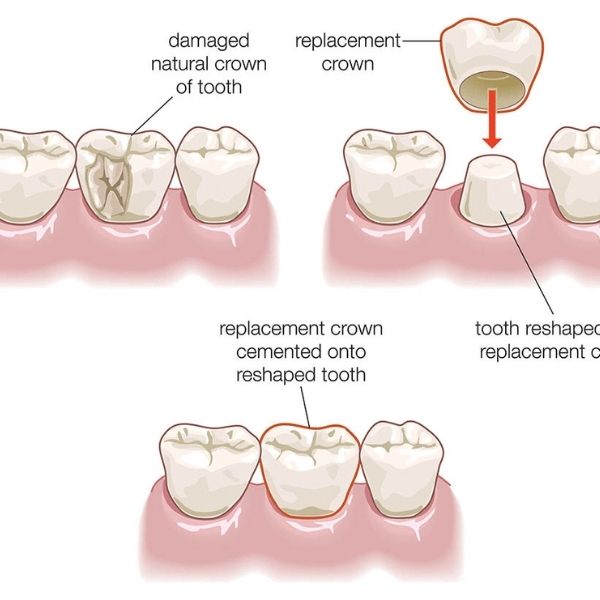 Custom dental crown placement