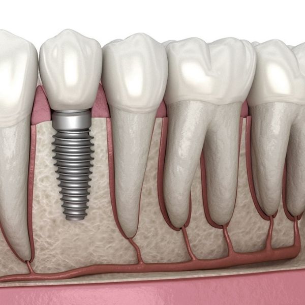Dental implant procedure at Dental Sedation Ottawa
