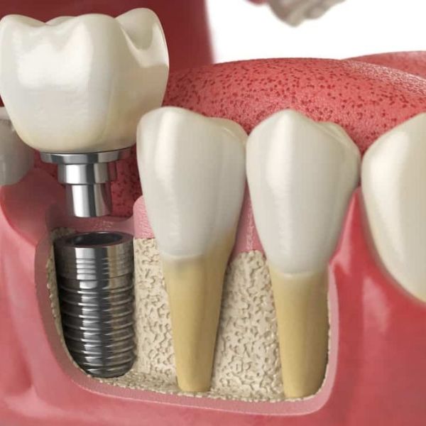 Implant-supported crowns and bridges