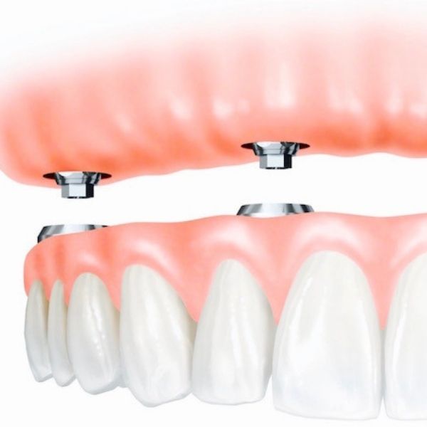 Implant-supported dentures
