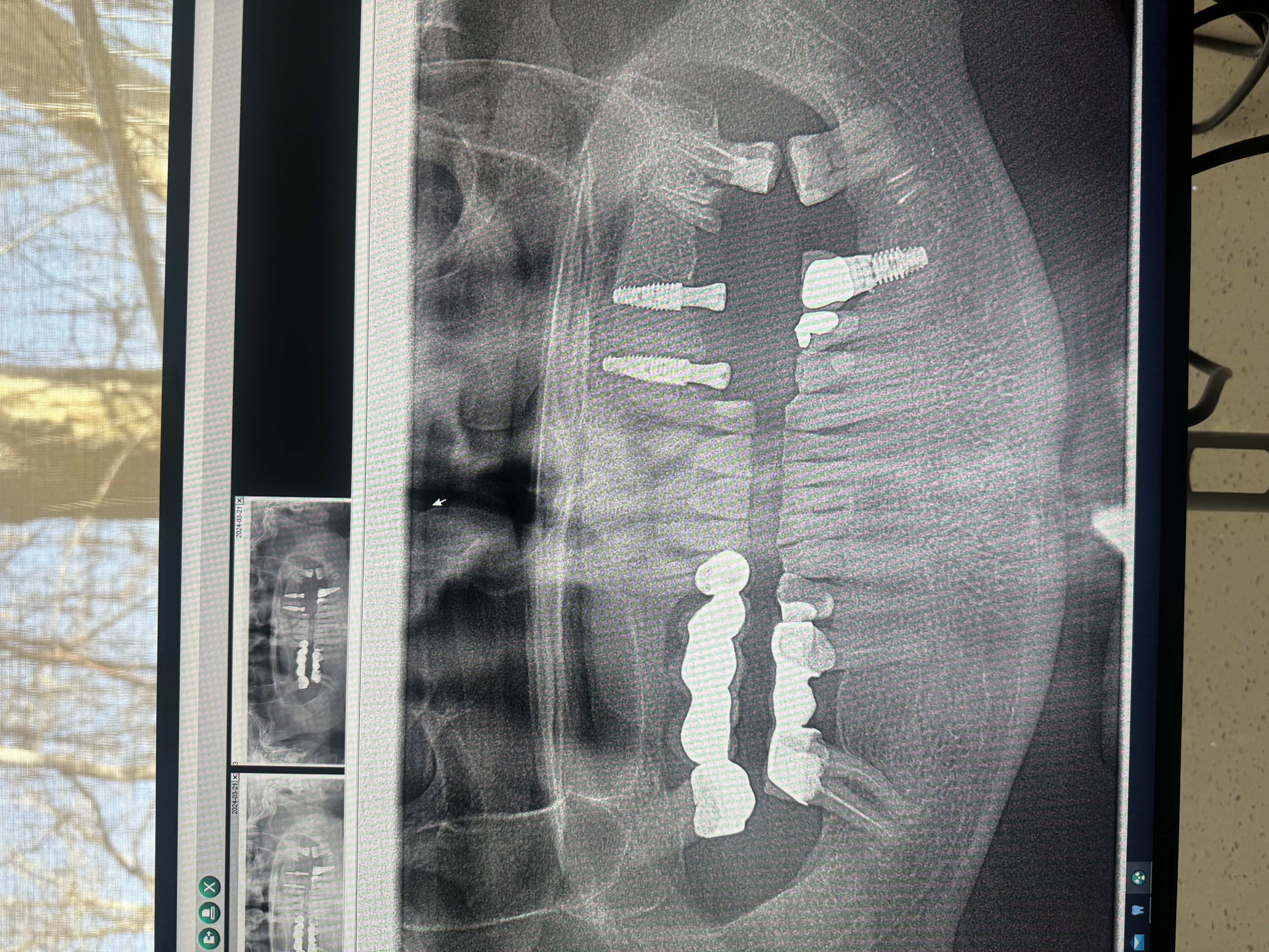 Panoramic X-ray showing multiple implants and full-mouth restoration