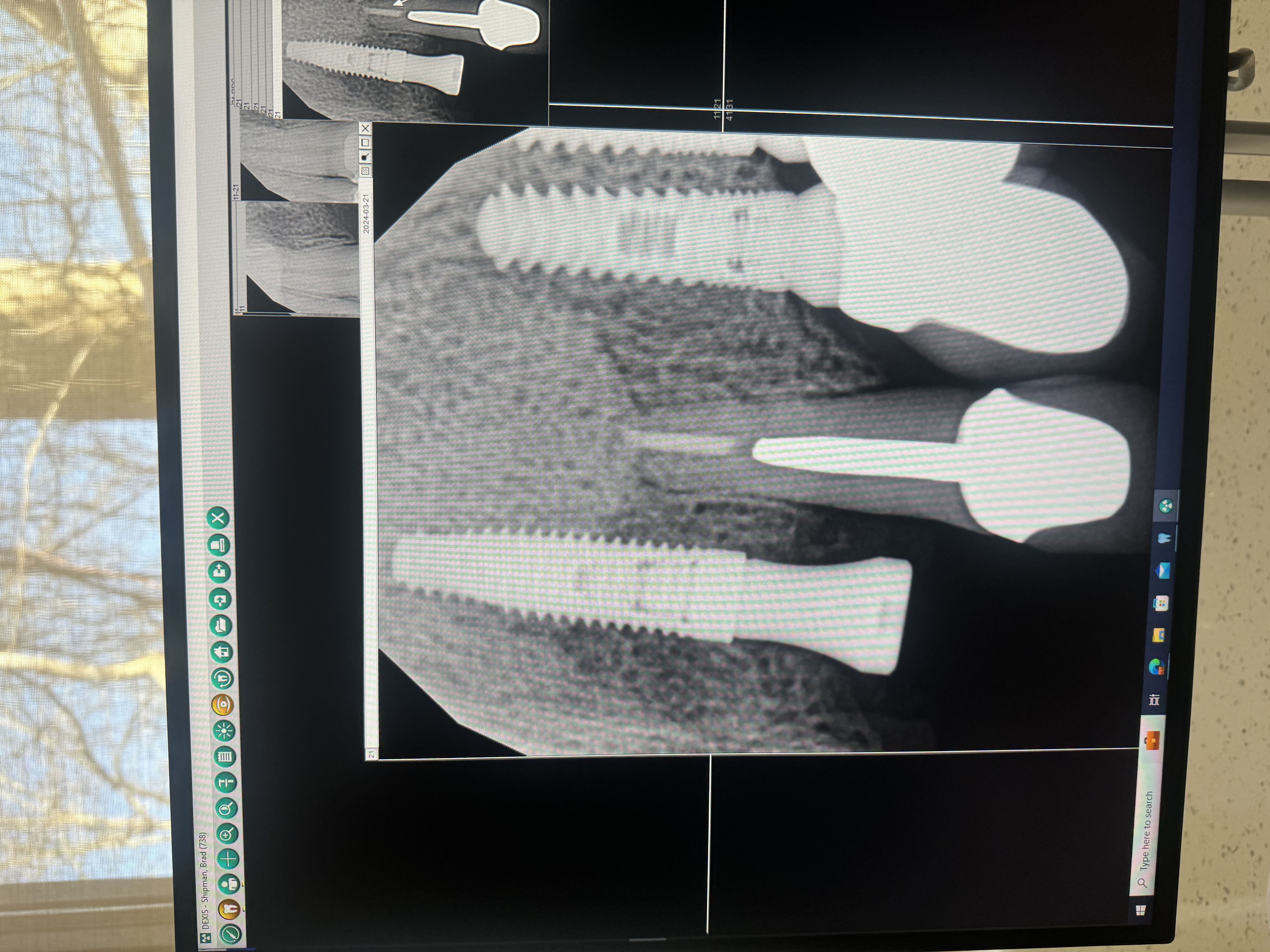 Periapical X-ray showing dental implant posts integrated with the jawbone