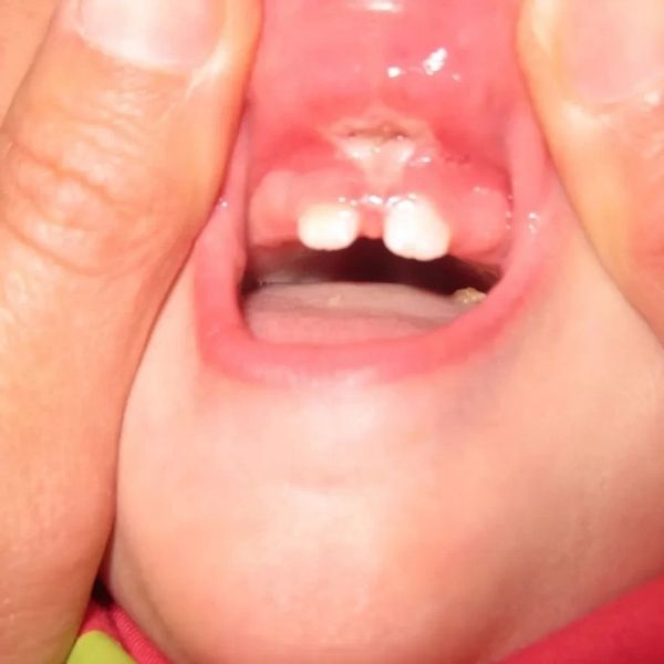 Lip-tie release procedure for infants and children