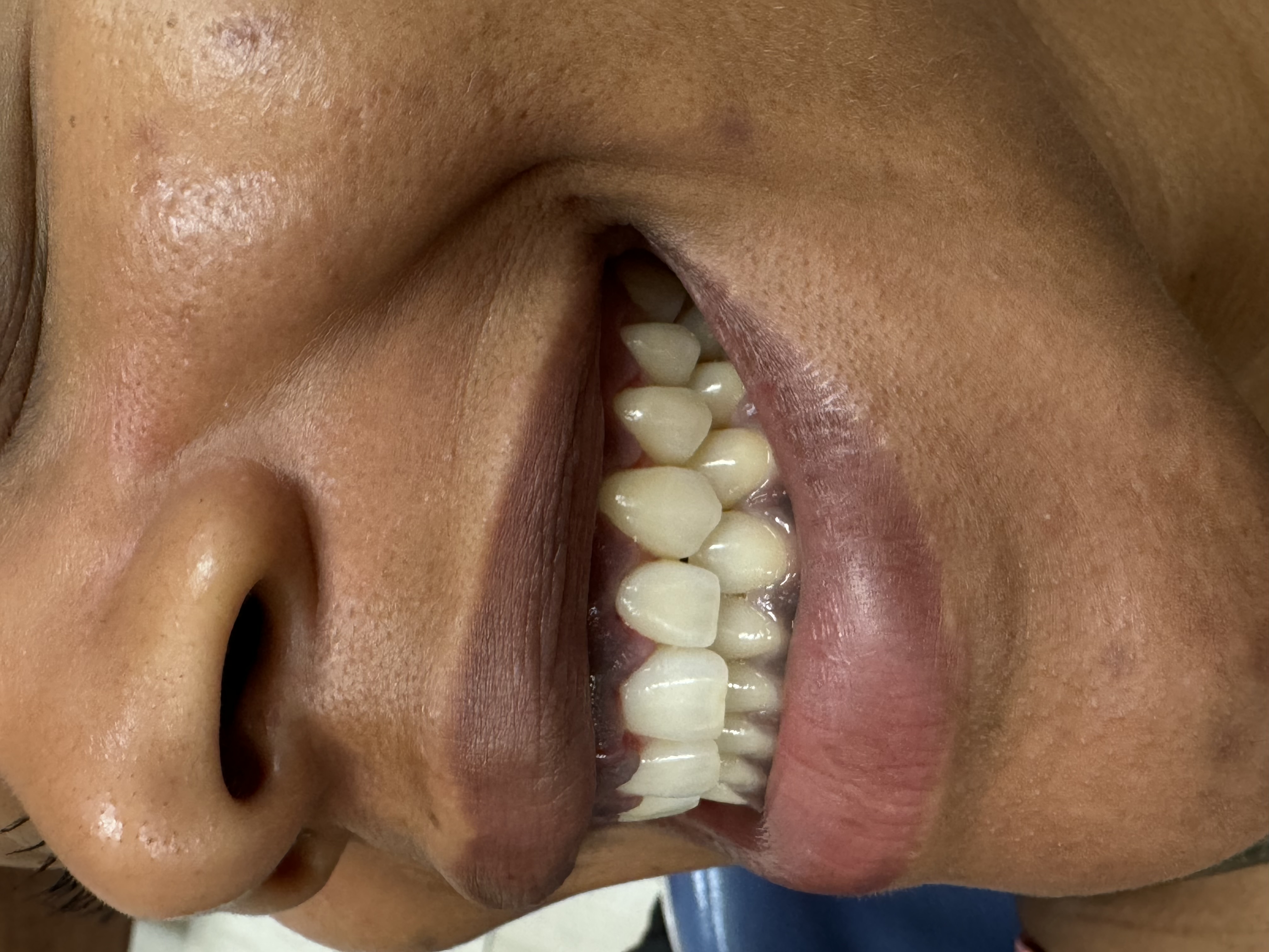 Happy patient smiling after dental treatment