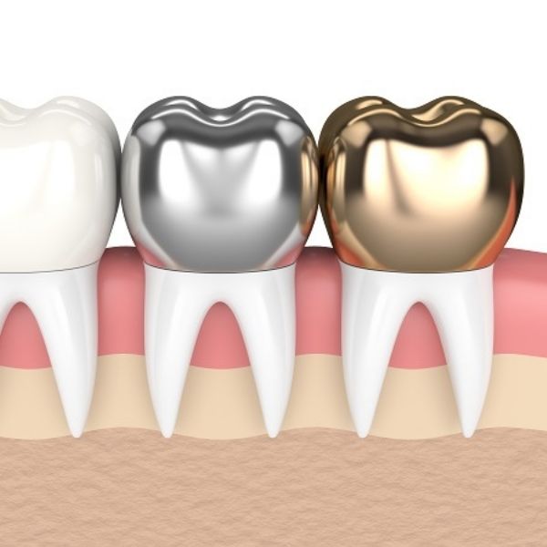 Esthetic strip crowns for childrens teeth