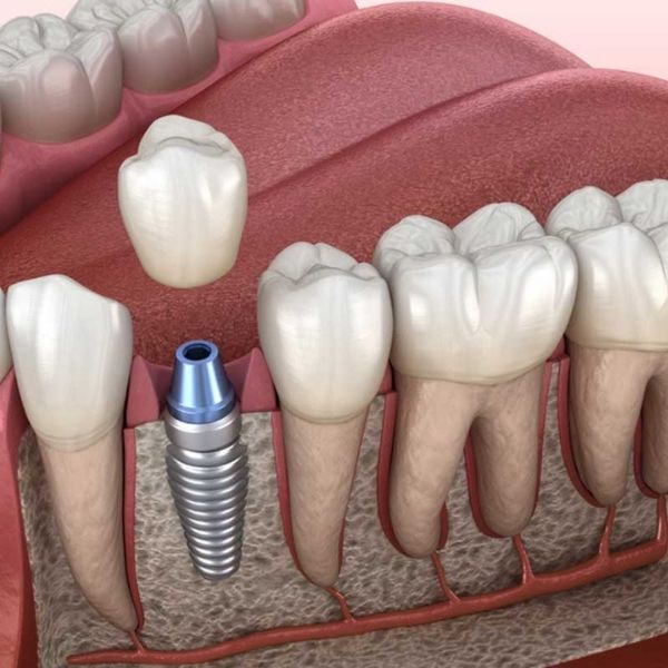 Single tooth dental implant