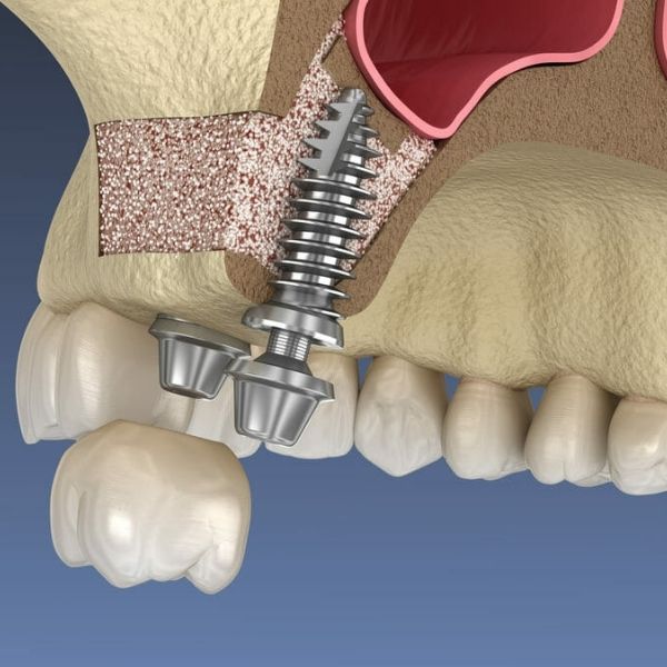 Sinus lift procedure for dental implants