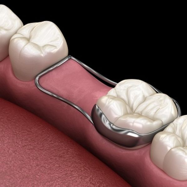 Space maintainer for childrens dental health